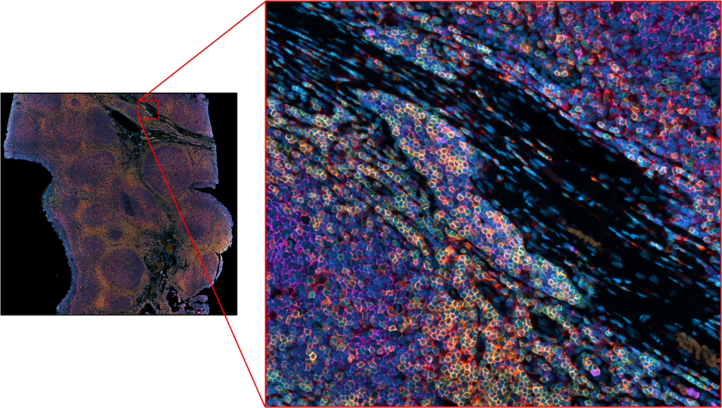 Immunofluorescent staining in FFPE human tonsil of Panel 1. CD3 (yellow), CD4 (red), CD20 (purple)
