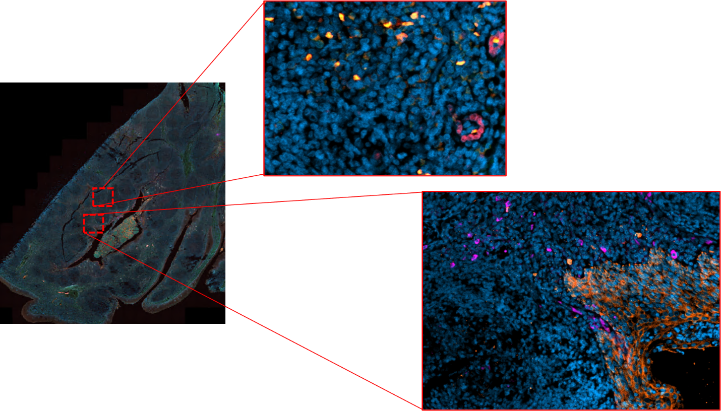 Immunofluorescent staining in FFPE human tonsil of Panel 2. PDL1 (purple), Granzyme B (red), FoxP3 (green); Yellow represents the co-expression of Granzyme B and FoxP3.