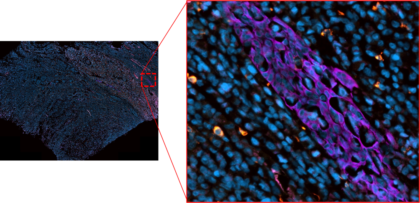 Immunofluorescent staining in FFPE human tonsil of Panel 3. CD56 (red), CD68 (yellow), PanCK (purple); Orange represents the co-expression of CD56 and CD68.