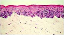 histology of Melanoma human tissue model