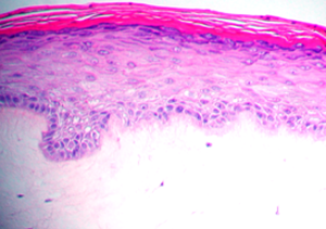 close up view of histology of Psoriasis human tissue model