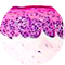 Melanoma