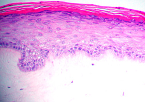 histology of Psoriasis human tissue model