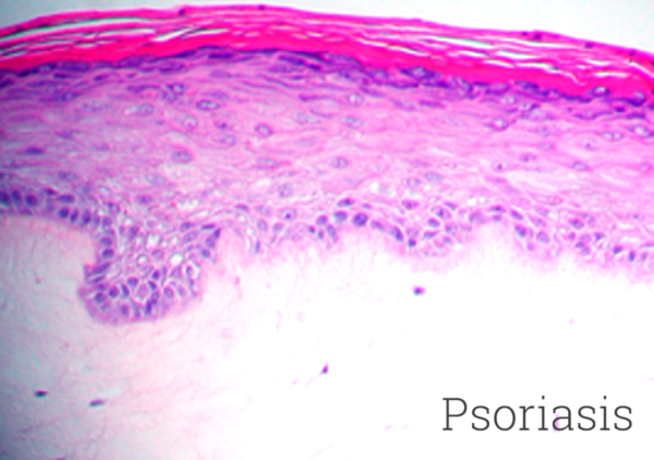 Psoriasis Histology New